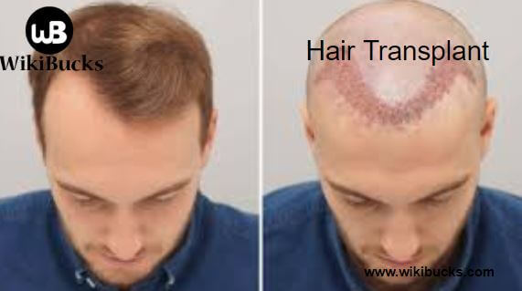 What is Hair Transplant and its Cost